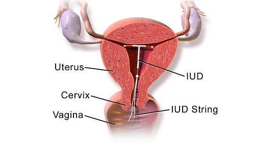 Hình ảnh vòng tránh thai trong buồng tử cung