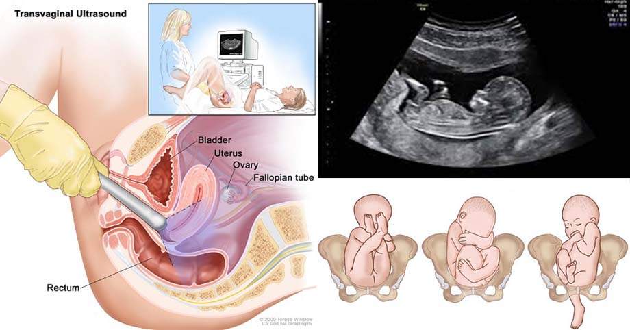 Khám thai lần đầu hoàn toàn có thể siêu âm đầu dò