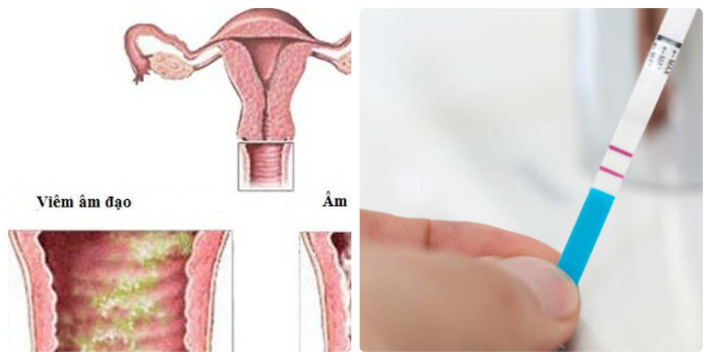 Bị viêm âm đạo dùng que thử thai có chính xác không?