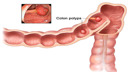 Bệnh polyp cổ tử cung