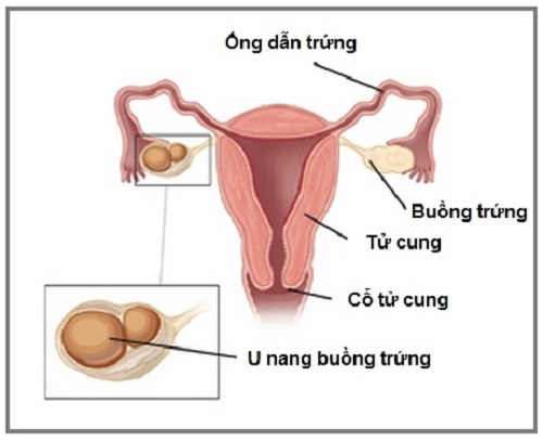 Hình ảnh khối u nang trong buồng trứng