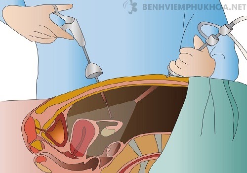U xơ cổ tử cung có thể chữa bằng mổ mở hoặc nội soi