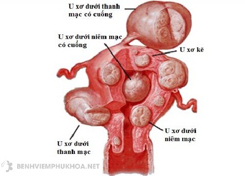 Bệnh u xơ cổ tử cung là gì? Hình ảnh về u xơ cổ tử cung và u xơ tử cung