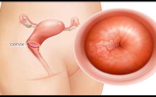 Bệnh viêm âm đạo nếu không điều trị kịp thời có thể gây viêm cổ tử cung