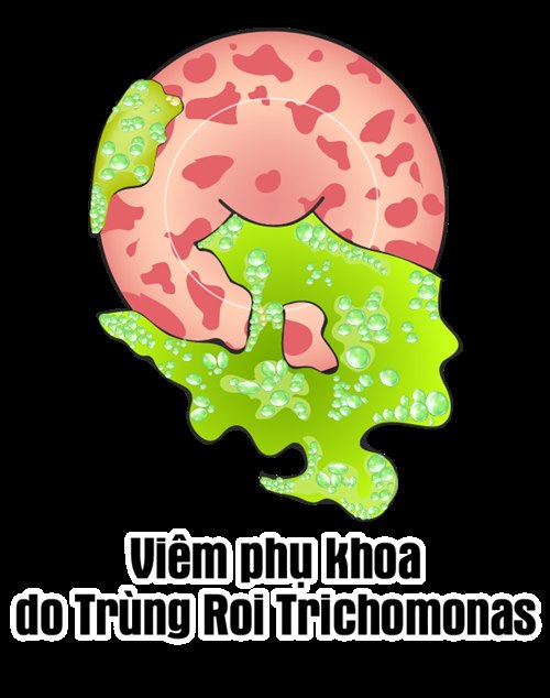 Viêm âm đạo do ký sinh trùng Trichomonas gây ra