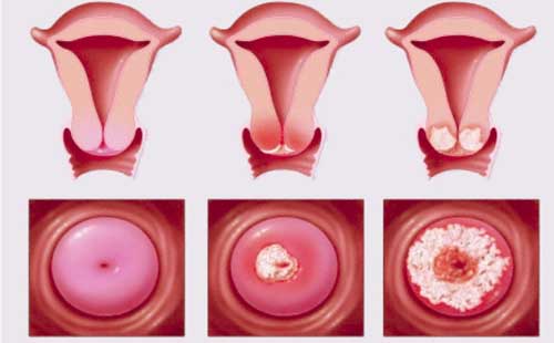 viêm âm đạo và viêm lộ tuyến cổ tử cung có giống nhau không