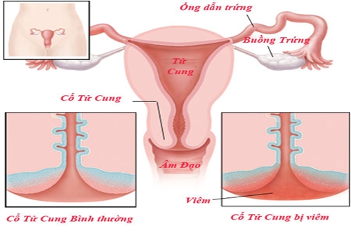 Viêm lộ tuyến cổ tử cung là căn bệnh khá phổ biến