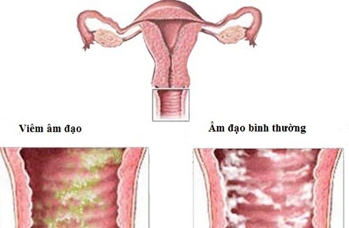 Bị viêm âm đạo có thai được không 