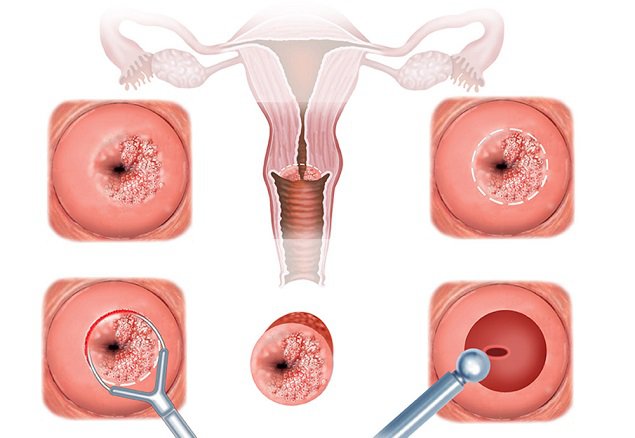Chữa viêm tử cung bằng tây y, phương pháp xâm lấn có thể gây nhiều rủi ro 