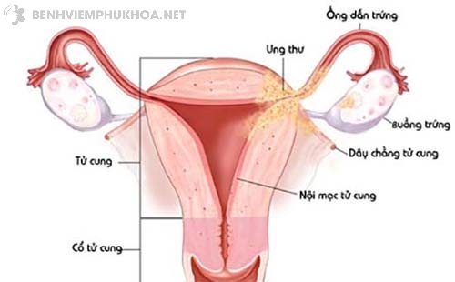 Bóc tách u xơ cổ tử cung có thể gây nhiễm trùng buồng trứng