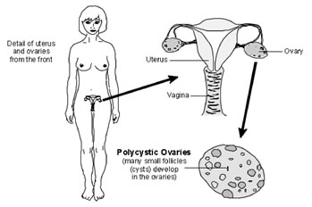 Mô tả về hội chứng buồng trứng đa nang ở cơ thể phụ nữ