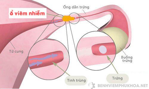 Viêm ống dẫn trứng có thể cản trở quá trình thụ tinh