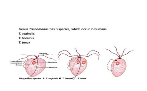 Viêm âm đạo do Trichomonas phổ biến nhất trong các loại viêm âm đạo