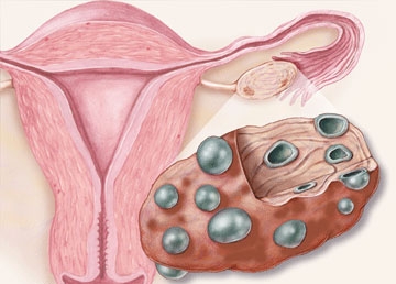 Hình ảnh về buồng trứng đa nang - nguyên nhân khiến chị em không thể mang thai