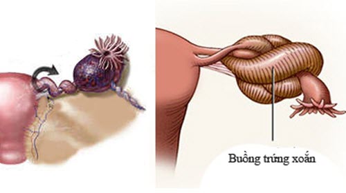 Hình ảnh mô tả u nang buồng trứng