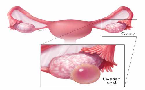 Dấu hiệu nhận biết u nang buồng trứng như thế nào?