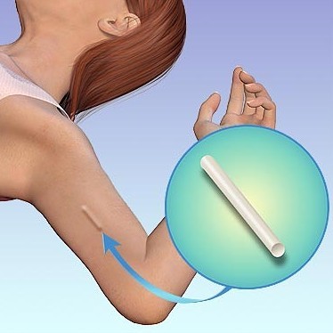 Hình ảnh mô tả về phương pháp cấy que tránh thai