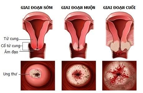 Cổ tử cung có sự thay đổi rõ rệt từ giai đoạn đầu đến giai đoạn cuối mắc bệnh viêm lộ tuyến cổ tử cung.