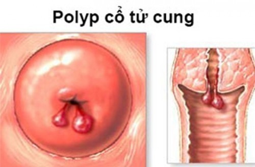 Hình ảnh polyp cổ tử cung