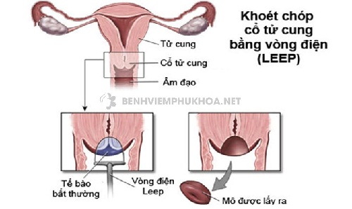 Chữa viêm cổ tử cung bằng LEEP là gì?