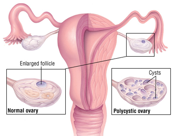 Buồng trứng đa nang là hội chứng khiến phụ nữ khó mang thai tự nhiên