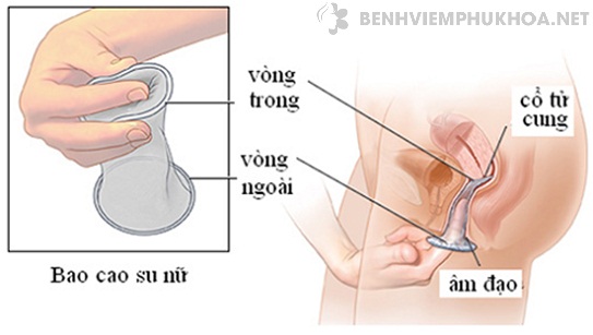 Nên dùng bao cao su khi đặt thuốc chữa viêm phụ khoa gia truyền họ Nguyễn