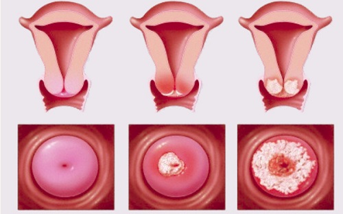 viêm cổ tử cung và cách điều trị