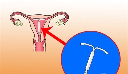 Hình ảnh vòng tránh thai đặt trong tử cung phụ nữ
