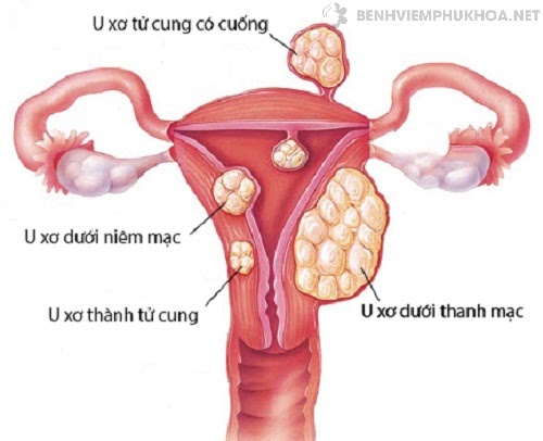 U xơ tử cung là một trong những nguyên nhân dẫn đến đau bụng kinh