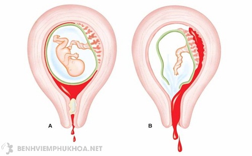 Dấu hiệu ung thư cổ tử cung khi mang thai là gì?