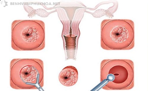 Điều trị nang naboth tử cung cần nhận biết sớm triệu chứng