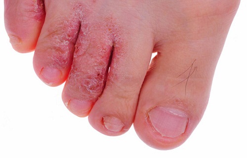 Vệ sinh chân sạch là cách phòng bệnh nấm chân candida