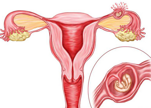 Tình trạng viêm ống dẫn trứng cản trở quá trình thụ thai