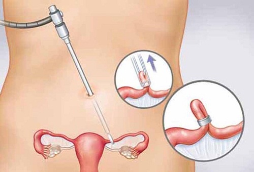Phẫu thuật nội soi cắt phần ống dẫn trứng bị viêm