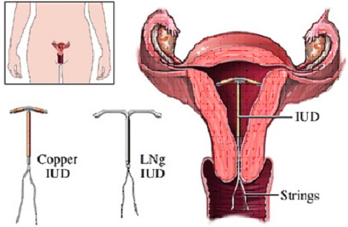 Hình ảnh vòng tránh thai trong tử cung
