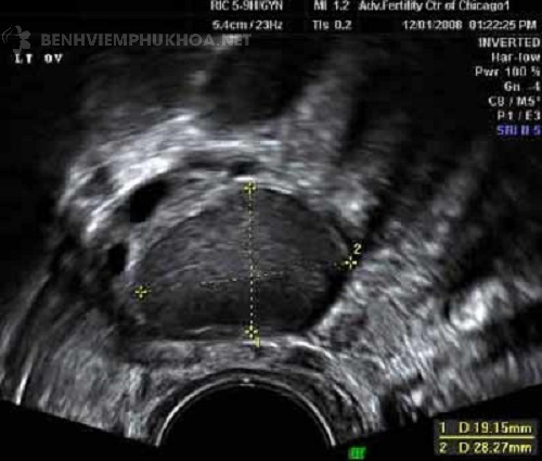 Hình ảnh u lạc nội mạc tử cung siêu âm