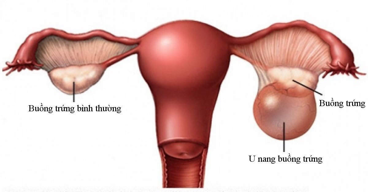 U nang buông trứng gồm u cơ năng và u thực thể