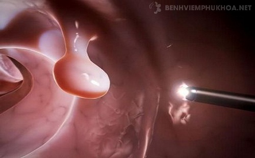 hình ảnh polyp cổ tử cung và điều trị ngoại khoa