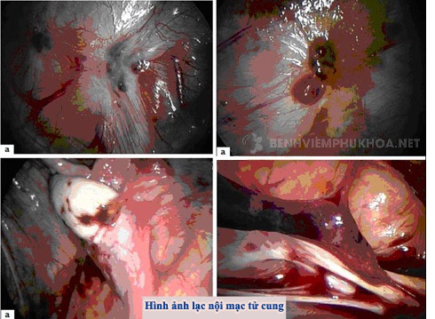 Hình ảnh siêu âm lạc nội mạc tử cung