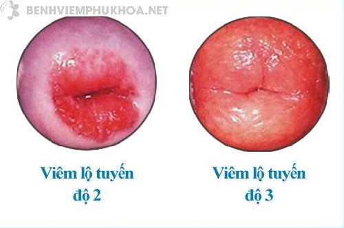 Hình ảnh viêm lộ tuyến cổ tử cung độ 1 và cách điều trị