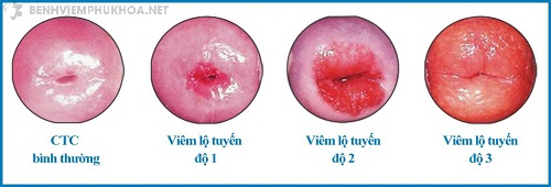 Hình ảnh viêm lộ tuyến cổ tử cung độ 3