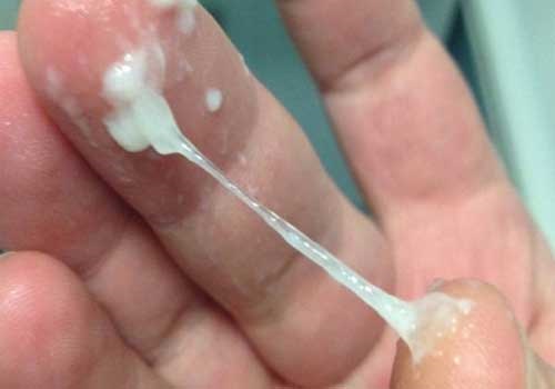 Khí hư màu trắng sữa không mùi là triệu chứng của bệnh phụ khoa