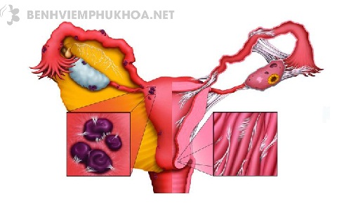 Lạc nội mạc tử cung ở tầng sinh môn dễ gây viêm nhiễm, tắc vòi trứng