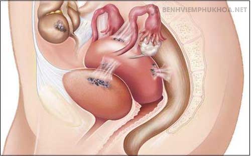 Lạc nội mạc tử cung ở thành bụng là gì?