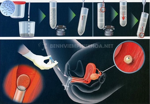 Lạc nội mạc tử cung thụ tinh nhân tạo bằng cách bơm tinh trùng vào buồng tử cung