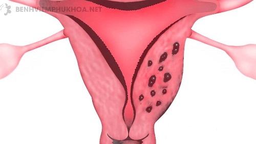 Lạc nội mạc tử cung trong cơ là gì?