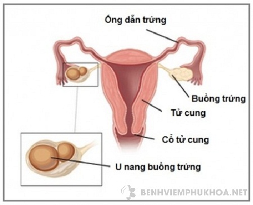 lạc nội mạc tử cung và u nang buồng trứng rất khác nhau