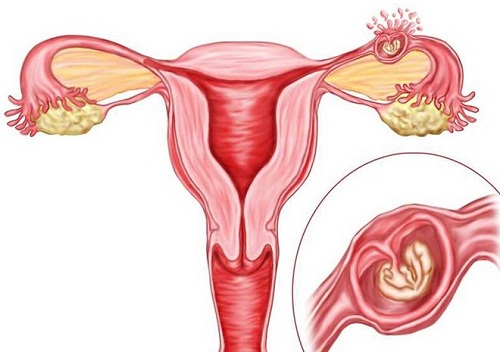 Viêm phần phụ có thể dẫn tới hiện tượng chửa ngoài tử cung