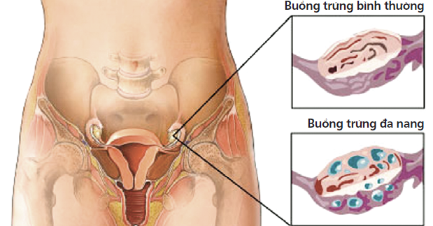 Hình ảnh về hội chứng buồng trứng đa nang