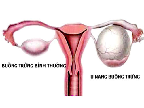 Hình ảnh mô tả u nang buồng trứng